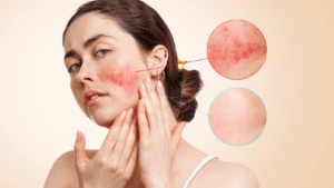 Alora Rejuvenation - Rosacea Awareness Month